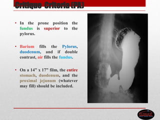 Critique Criteria (PA)
• In the prone position the
fundus is superior to the
pylorus.
• Barium fills the Pylorus,
duodenum, and if double
contrast, air fills the fundus.
• On a 14” x 17” film, the entire
stomach, duodenum, and the
proximal jejunum (whatever
may fill) should be included.
 