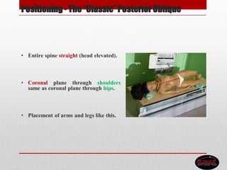 Positioning - The “Classic”Posterior Oblique
• Entire spine straight (head elevated).
• Coronal plane through shoulders
same as coronal plane through hips.
• Placement of arms and legs like this.
 