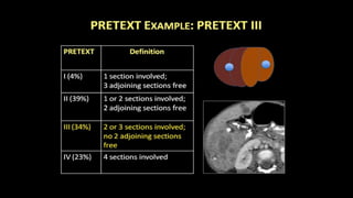 Pretext 3 Pediatric hepatic masses radiology -CT MRI USG | PPTX