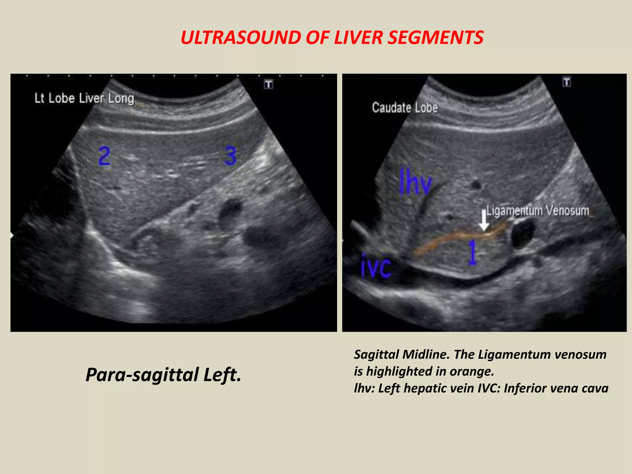 Abdominal Ultrasound Anatomy Image | Radiopaedia.org