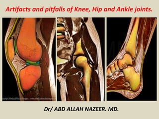Artifacts and pitfalls of Knee, Hip and Ankle joints.
Dr/ ABD ALLAH NAZEER. MD.
 