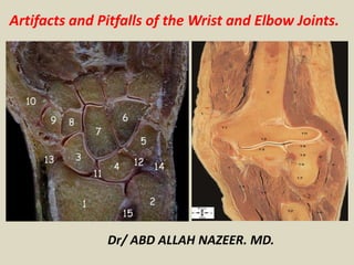 Dr/ ABD ALLAH NAZEER. MD.
Artifacts and Pitfalls of the Wrist and Elbow Joints.
 