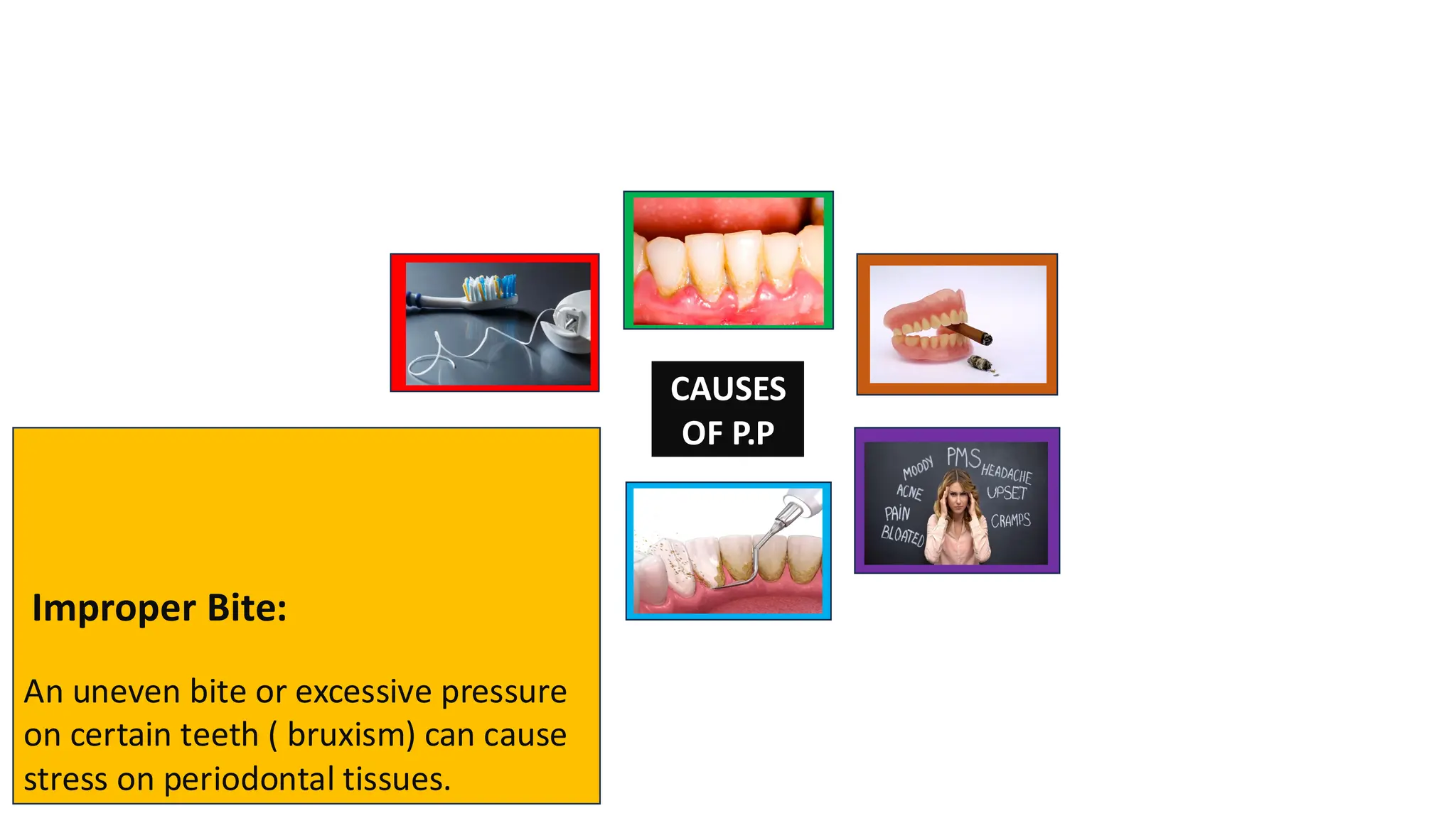 CAUSES
OF P.P
Improper Bite:
An uneven bite or excessive pressure
on certain teeth ( bruxism) can cause
stress on periodontal tissues.
 
