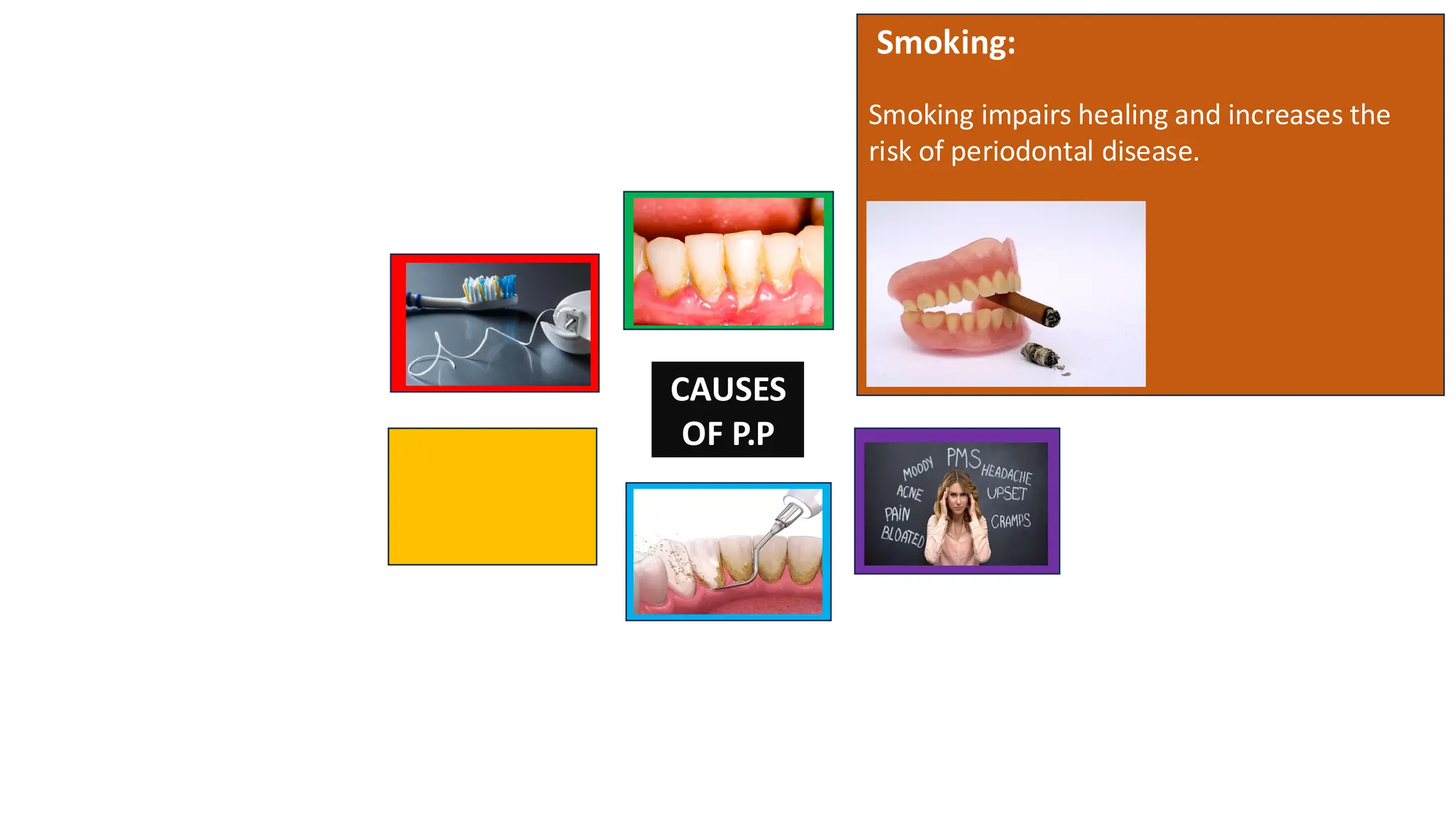 Smoking:
Smoking impairs healing and increases the
risk of periodontal disease.
CAUSES
OF P.P
 