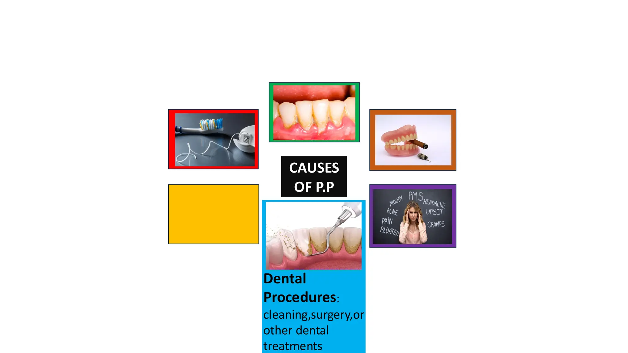 CAUSES
OF P.P
Dental
Procedures:
cleaning,surgery,or
other dental
treatments
 
