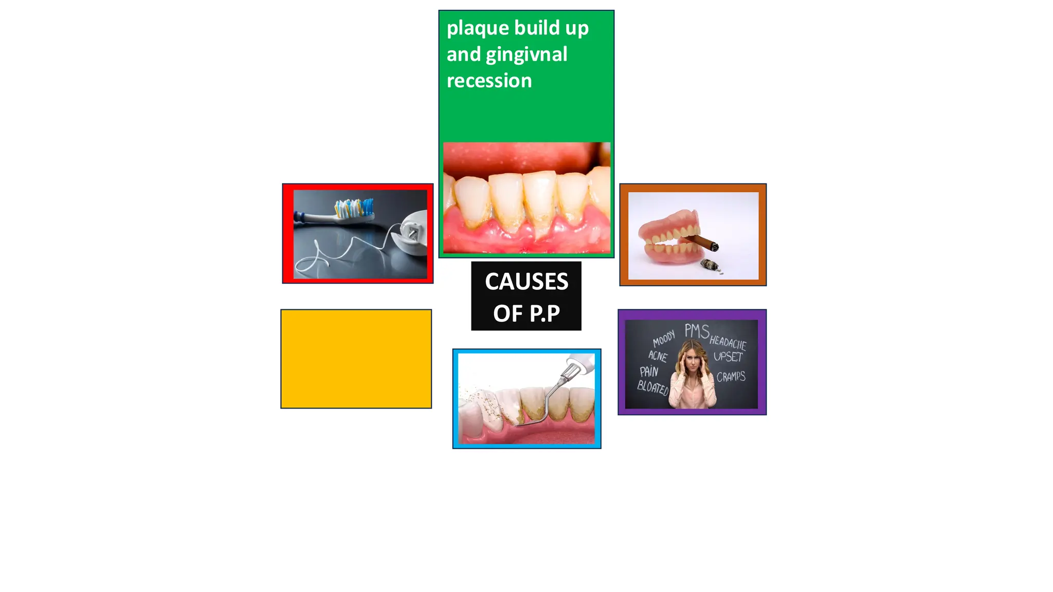 CAUSES
OF P.P
plaque build up
and gingivnal
recession
 