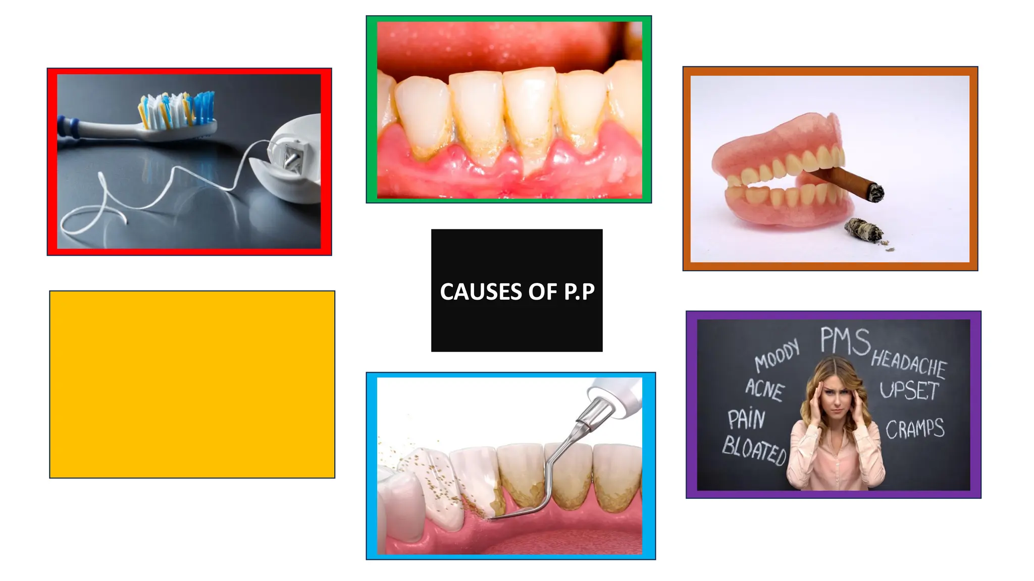 CAUSES OF P.P
 