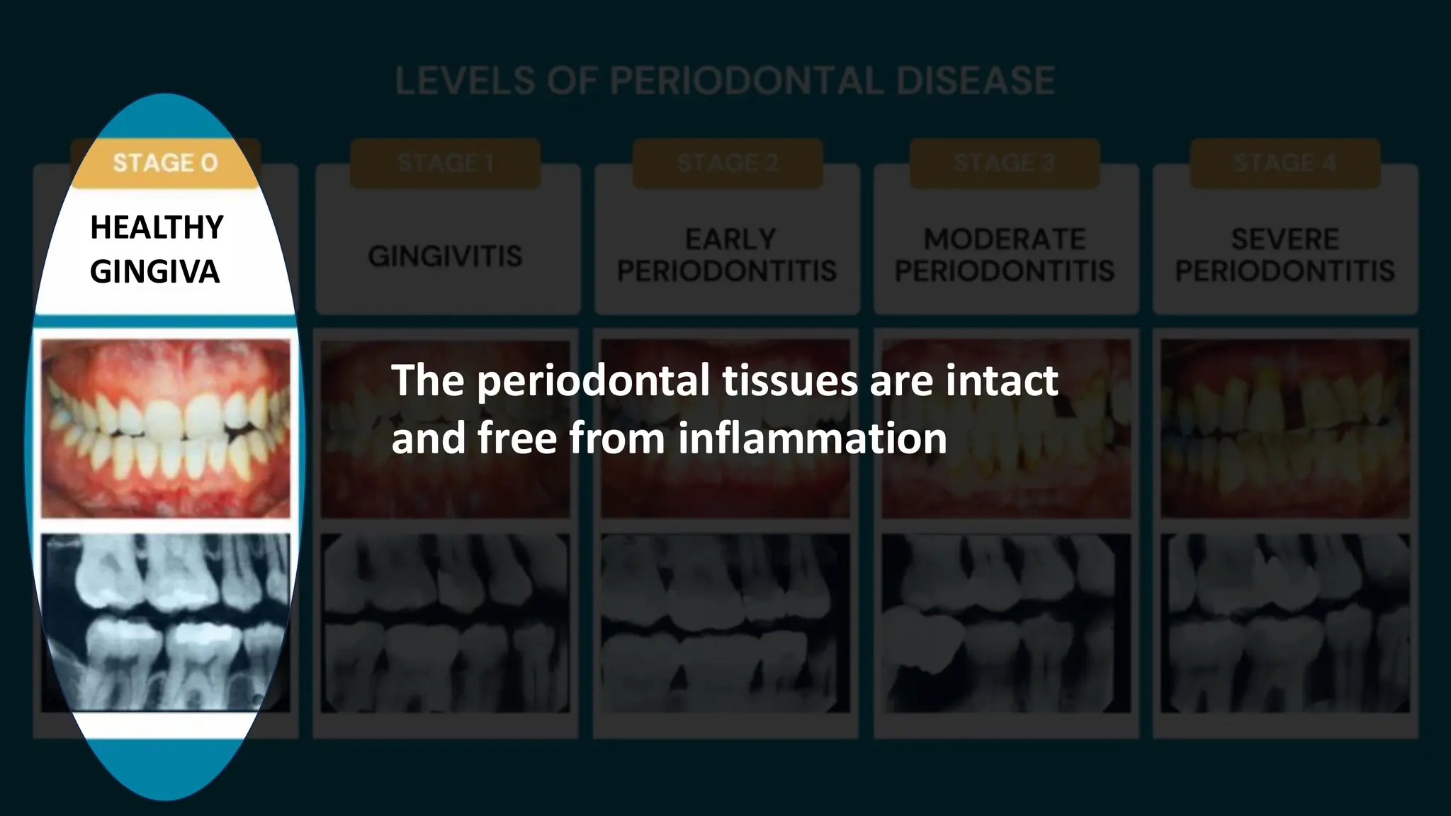 HEALTHY
GINGIVA
The periodontal tissues are intact
and free from inflammation
 