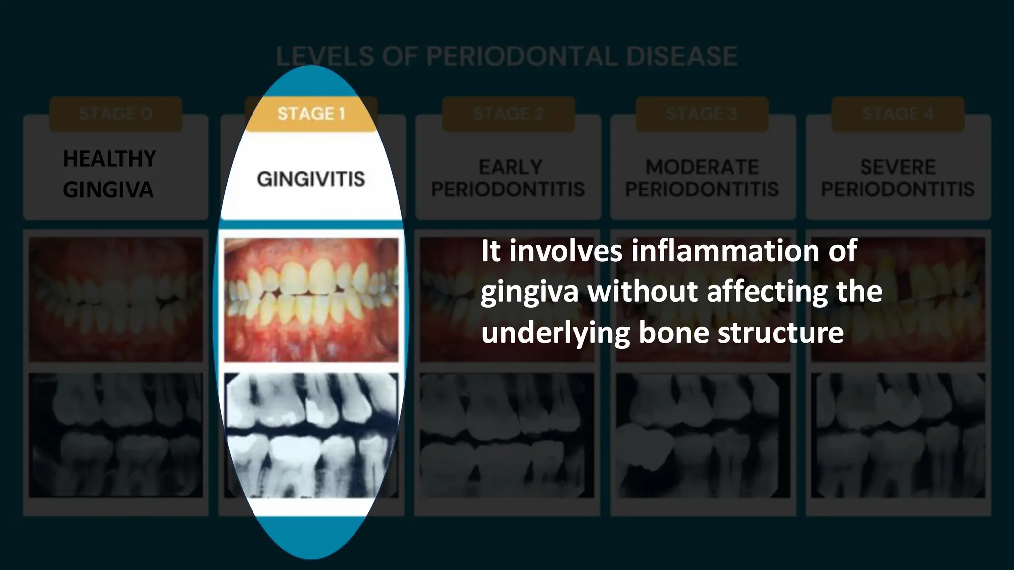 HEALTHY
GINGIVA
It involves inflammation of
gingiva without affecting the
underlying bone structure
 