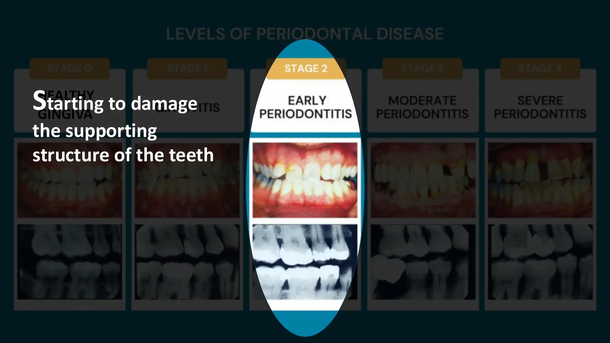HEALTHY
GINGIVA
Starting to damage
the supporting
structure of the teeth
 