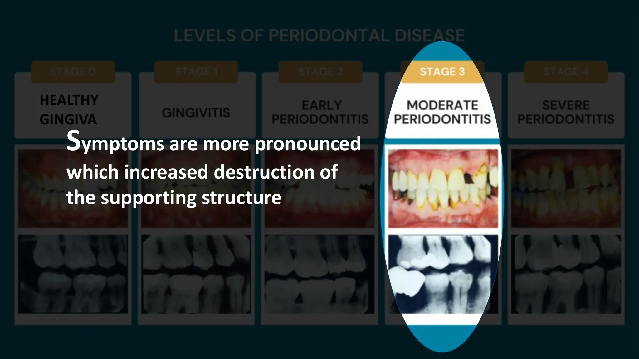 HEALTHY
GINGIVA
Symptoms are more pronounced
which increased destruction of
the supporting structure
 