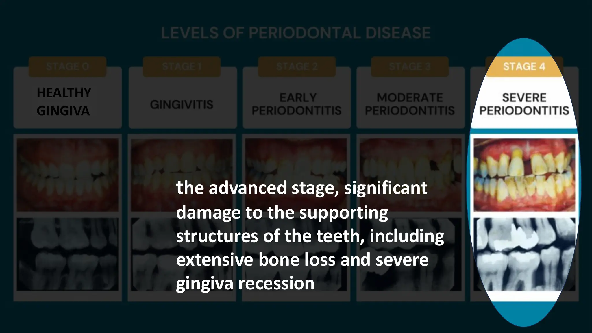 HEALTHY
GINGIVA
the advanced stage, significant
damage to the supporting
structures of the teeth, including
extensive bone loss and severe
gingiva recession
 