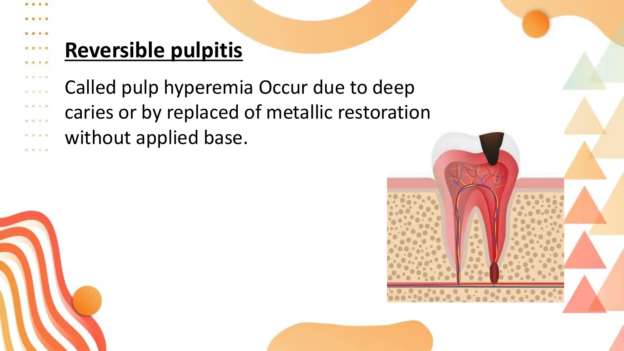 Reversible pulpitis
Called pulp hyperemia Occur due to deep
caries or by replaced of metallic restoration
without applied base.
 
