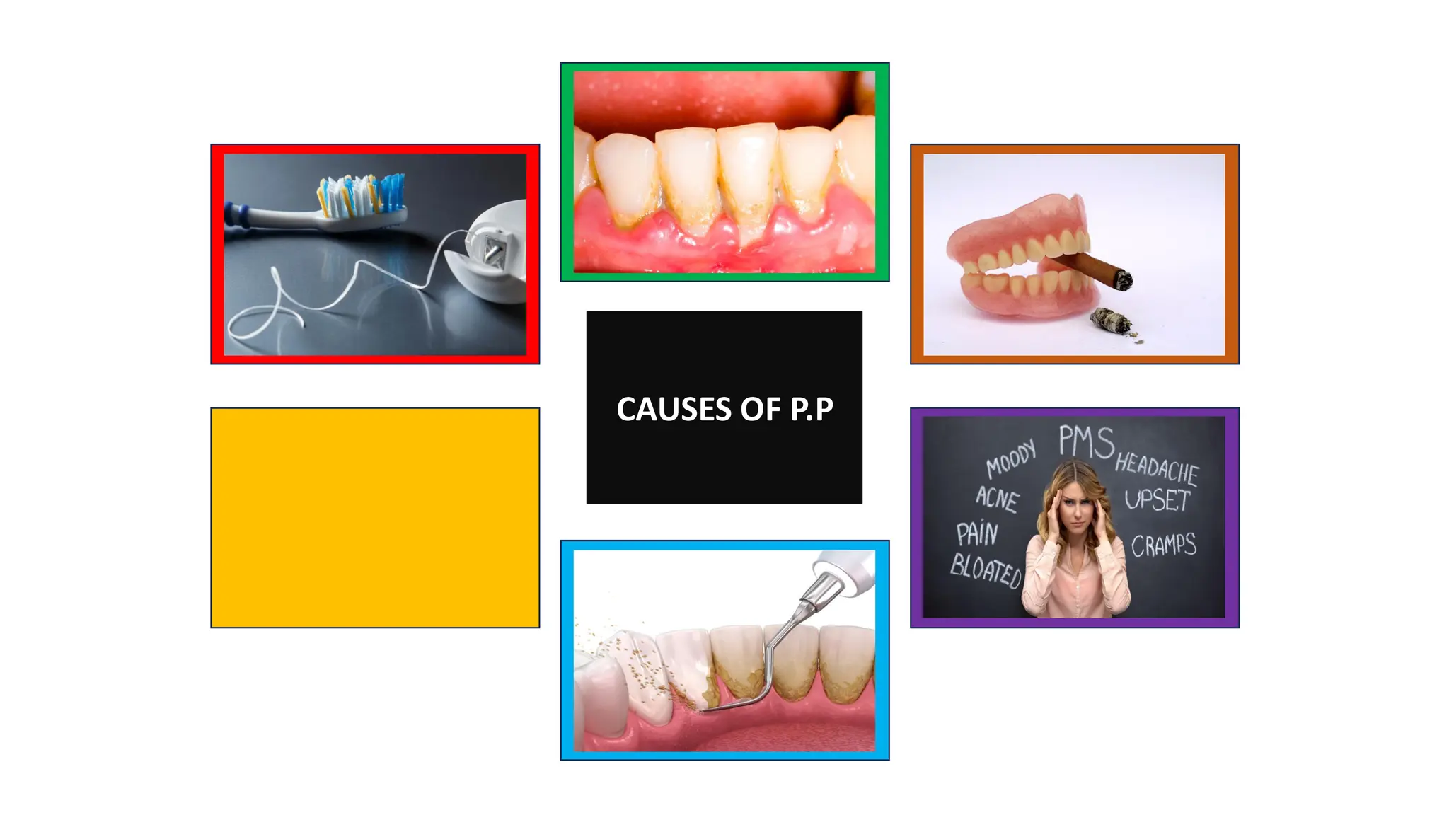 CAUSES OF P.P
 