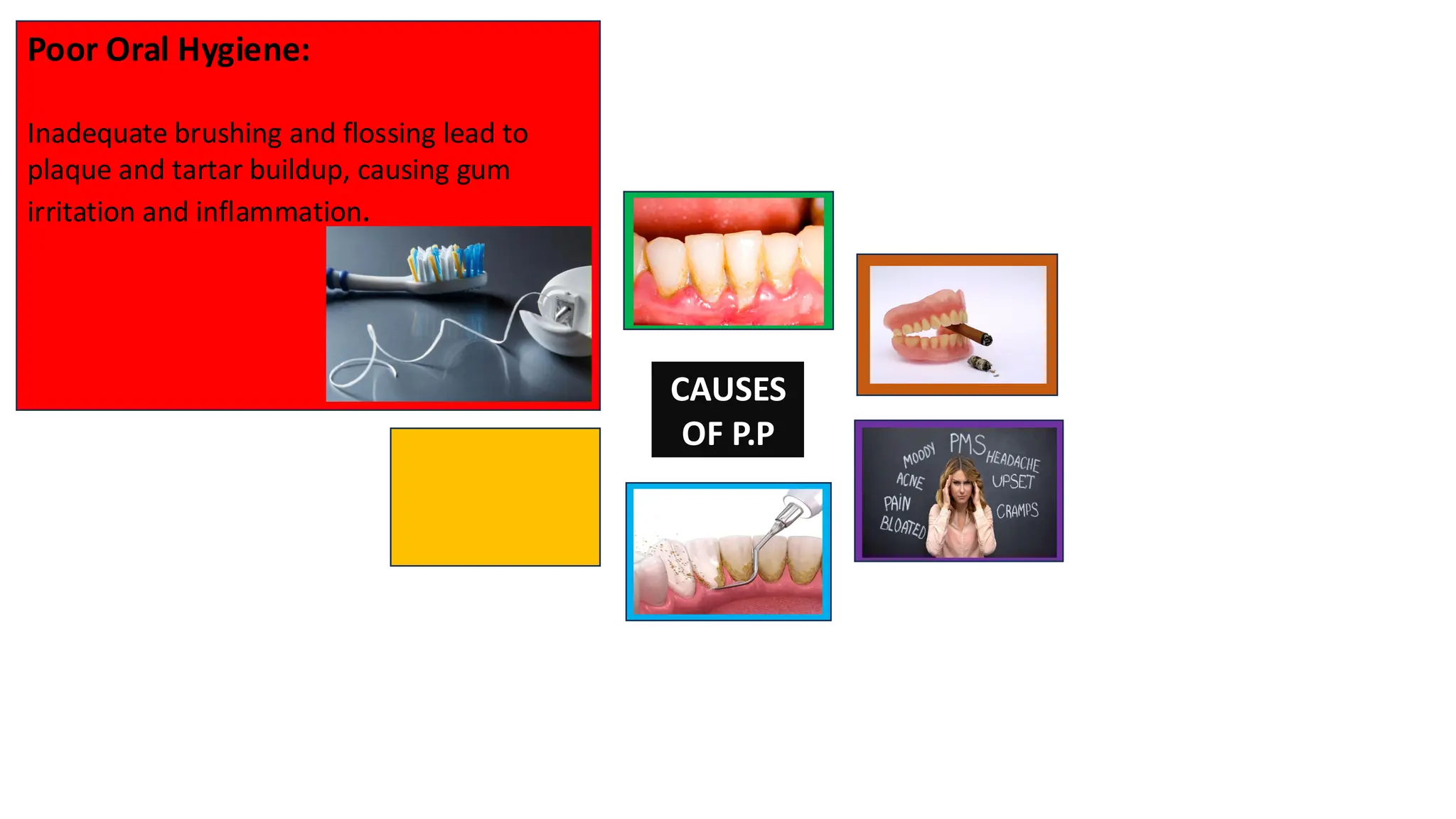CAUSES
OF P.P
Poor Oral Hygiene:
Inadequate brushing and flossing lead to
plaque and tartar buildup, causing gum
irritation and inflammation.
 