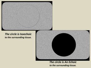 The circle is Isoechoic
to the surrounding tissue.
The circle is An Echoic
to the surrounding tissue.
 