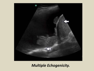 Multiple Echogenicity.
 