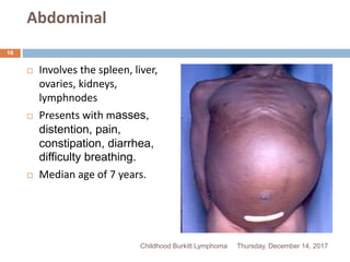 BURKITTS LYMPHOMA | PPTX