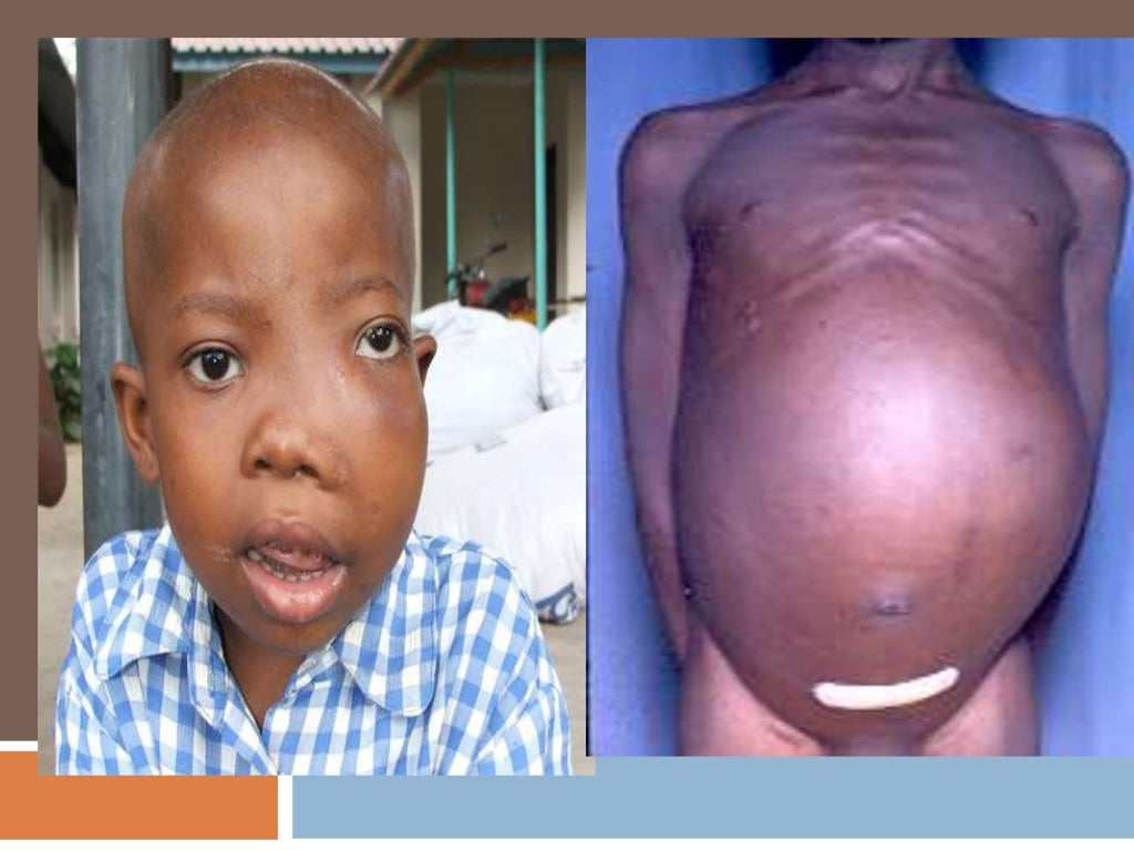 BURKITTS LYMPHOMA