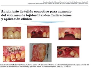 Volumen 20 - Nº 2 - Agosto 2008
Fig.1: Zona prequirúrgica, clase III de Seibert.
Fig.2: Zona prequirúgica tras la extracción del póntico.
Fig.4: Preparación del lecho receptor desde vestibular.
Fig.5: Injerto de tejido conectivo.
Volumen 20 - Nº 2 - Agosto 2008
Fig.1: Zona prequirúrgica, clase III de Seibert.
Fig.2: Zona prequirúgica tras la extracción del póntico.
Fig.4: Preparación del lecho receptor desde vestibular.
Fig.5: Injerto de tejido conectivo.
Volumen 20 - Nº 2 - Agosto 2008
Se procede a la obtención del injerto de tejido conec-
tivo de la zona donante palatina (Fig. 5) mediante la
técnica descrita por Bruno. Suturamos la zona palatina
con puntos simples y se realiza una ligera presión so-
bre la zona mediante gasas para facilitar la hemosta-
sia (Fig. 6). Mientras procedemos a acondicionar la
zona receptora, mantendremos el injerto en una gasa
impregnada en suero salino (10).
Fig.1: Zona prequirúrgica, clase III de Seibert.
Fig.2: Zona prequirúgica tras la extracción del póntico.
Fig.3: Preparación del lecho receptor desde el plano oclusal.
Fig.4: Preparación del lech
Fig.6: Sutura de la zona da
Fig.5: Injerto de tejido con
Volumen 20 - Nº 2 - Agosto 2008
Fig.1: Zona prequirúrgica, clase III de Seibert.
Fig.2: Zona prequirúgica tras la extracción del póntico.
Fig.4: Preparación del lecho receptor desde vestibular.
Fig.5: Injerto de tejido conectivo.
nec-
te la
atina
n so-
osta-
ar la
gasa
Fig.4: Preparación del lecho receptor desde vestibular.
Fig.6: Sutura de la zona dadora.
Fig.5: Injerto de tejido conectivo.
Volumen 20 - Nº 2 - Agosto 2008
Se procede a la obtención del injerto de tejido conec-
tivo de la zona donante palatina (Fig. 5) mediante la
técnica descrita por Bruno. Suturamos la zona palatina
con puntos simples y se realiza una ligera presión so-
bre la zona mediante gasas para facilitar la hemosta-
sia (Fig. 6). Mientras procedemos a acondicionar la
Fig.1: Zona prequirúrgica, clase III de Seibert.
Fig.2: Zona prequirúgica tras la extracción del póntico.
Fig.3: Preparación del lecho receptor desde el plano oclusal.
Fig.4: Preparación del lecho re
Fig.5: Injerto de tejido conectiv
Escudero-Castaño N, Lorenzo-Vignau R, Perea-García MA, Bascones- Martínez A. Autoinjerto de tejido conectivo para aumento del
volumen de tejidos blandos. Indicaciones y aplicación clínica. Av PeriodonImplantol. 2008; 20, 2: 113-120.
 