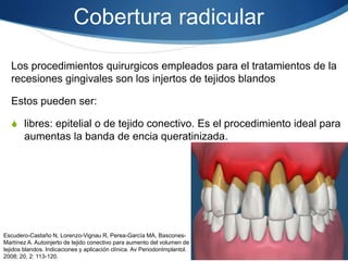 Cobertura radicular
Los procedimientos quirurgicos empleados para el tratamientos de la
recesiones gingivales son los injertos de tejidos blandos
Estos pueden ser:
S libres: epitelial o de tejido conectivo. Es el procedimiento ideal para
aumentas la banda de encia queratinizada.
Escudero-Castaño N, Lorenzo-Vignau R, Perea-García MA, Bascones-
Martínez A. Autoinjerto de tejido conectivo para aumento del volumen de
tejidos blandos. Indicaciones y aplicación clínica. Av PeriodonImplantol.
2008; 20, 2: 113-120.
 