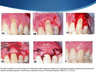 Escudero-Castaño N, Lorenzo-Vignau R, Perea-García MA, Bascones- Martínez A. Autoinjerto de tejido conectivo para aumento del
volumen de tejidos blandos. Indicaciones y aplicación clínica. Av PeriodonImplantol. 2008; 20, 2: 113-120.
 