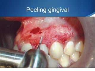 Peeling gingival
 
