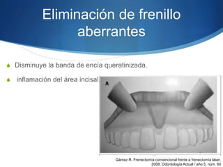 Eliminación de frenillo
aberrantes
S Disminuye la banda de encía queratinizada.
S inflamación del área incisal.
Gámez R. Frenectomía convencional frente a frenectomía láser,
2008. Odontología Actual / año 5, núm. 60
 