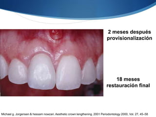 2 meses después
provisionalización
18 meses
restauración final
Michael g. Jorgensen & hessam nowzari. Aesthetic crown lengthening. 2001 Periodontology 2000, Vol. 27, 45–58
 