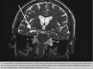 T2 weighted MRI. This image demonstrates an abnormality in the right mesial temporal lobe. It is shrunken and malformed
with enlargement of the temporal horn of the lateral ventricle. There is also a small area of abnormal high T2 signal within
the right hippocampus. The left hippocampus is relatively normal.
 