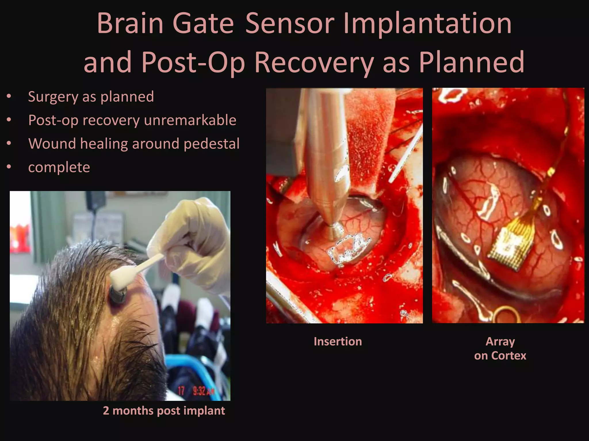 Brain Gate Sensor Implantation
and Post-Op Recovery as Planned
• Surgery as planned
• Post-op recovery unremarkable
• Wound healing around pedestal
• complete
Array
on Cortex
Insertion
2 months post implant
 