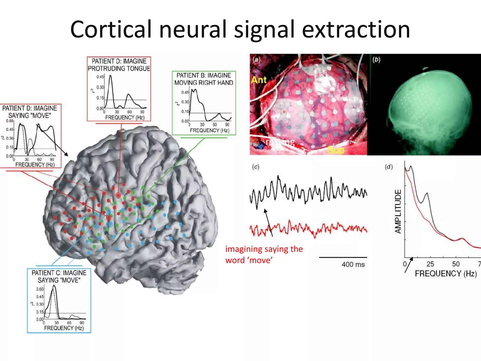 Cortical neural signal extraction
imagining saying the
word ‘move’
resting
 