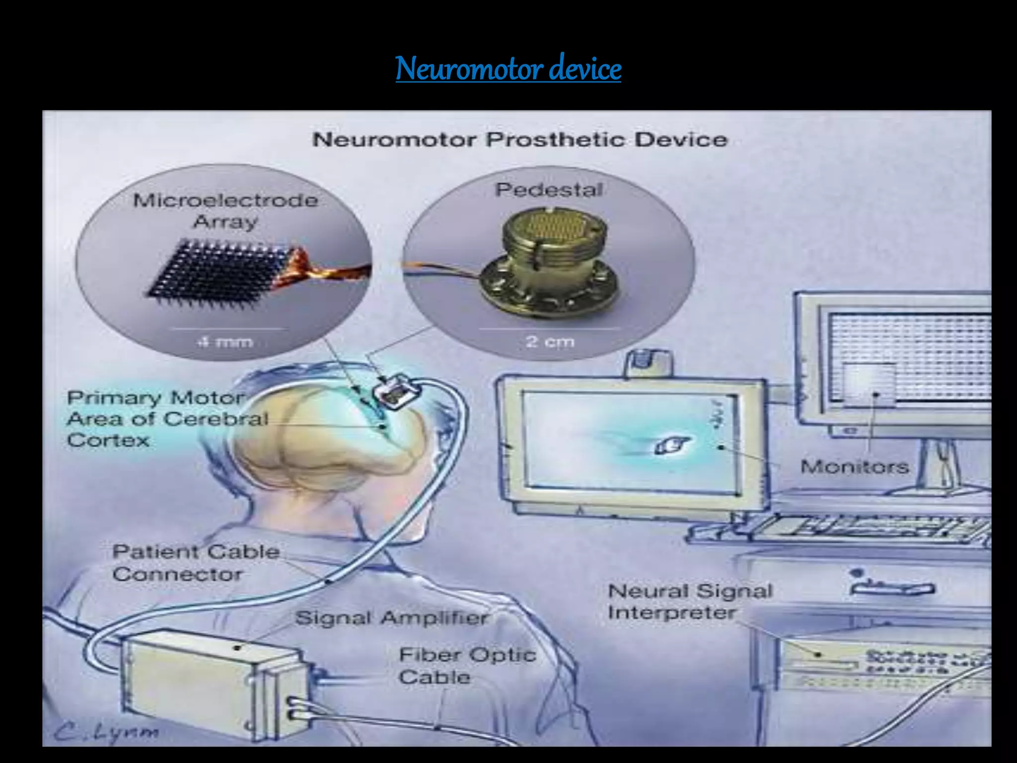 Neuromotor device
 