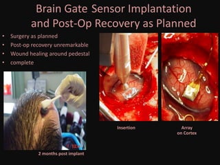 Brain Gate Sensor Implantation
and Post-Op Recovery as Planned
• Surgery as planned
• Post-op recovery unremarkable
• Wound healing around pedestal
• complete
Array
on Cortex
Insertion
2 months post implant
 