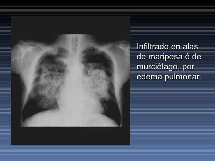 Presentation1 EDEMA AGUDO DEL PULMON