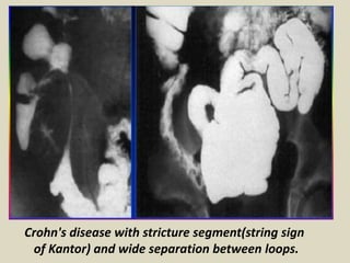 Presentation1, film readiing for barium studies. | PPTX