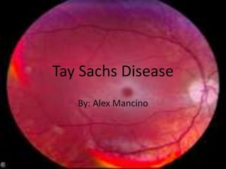 Tay Sachs Disease
   By: Alex Mancino
 