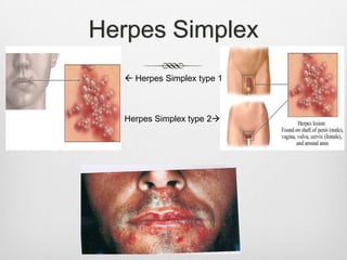 Herpes Simplex
   Herpes Simplex type 1



  Herpes Simplex type 2
 