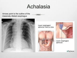 Achalasia
Arrows point to the outline of the
massively dilated esophagus
 