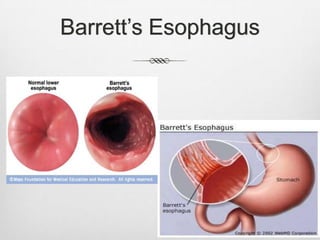 Barrett’s Esophagus
 