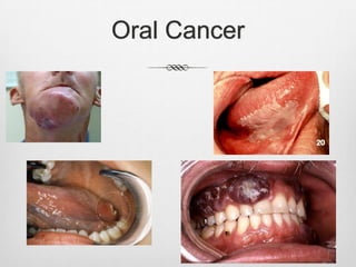 Oral Cancer
 
