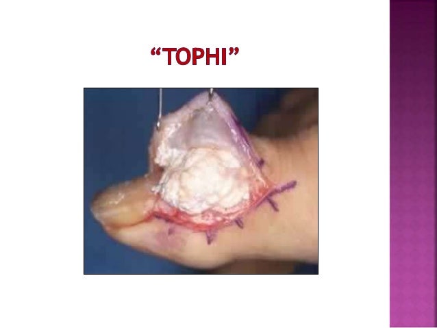 Presentation1(gout)