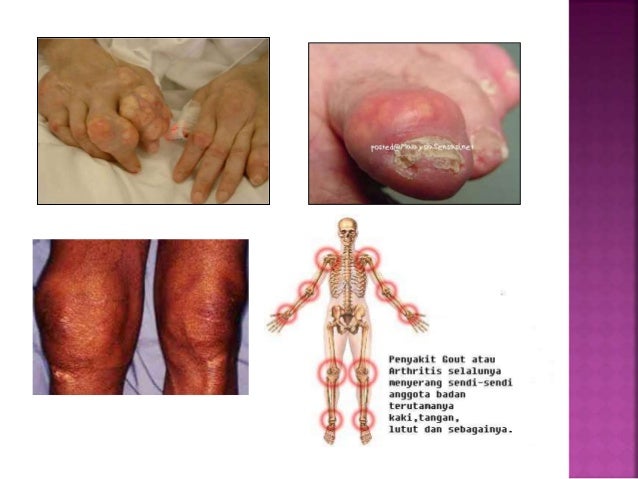 Presentation1(gout)
