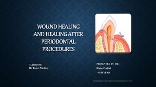 WOUND HEALING
AND HEALINGAFTER
PERIODONTAL
PROCEDURES
GUIDED BY:
Dr Tanvi Mehta
PRESENTED BY: DR.
Rutu Dabhi
PG II YEAR
 