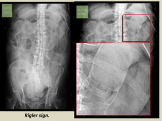 Presentation1, interpretation of x ray of the abdomen. | PPTX