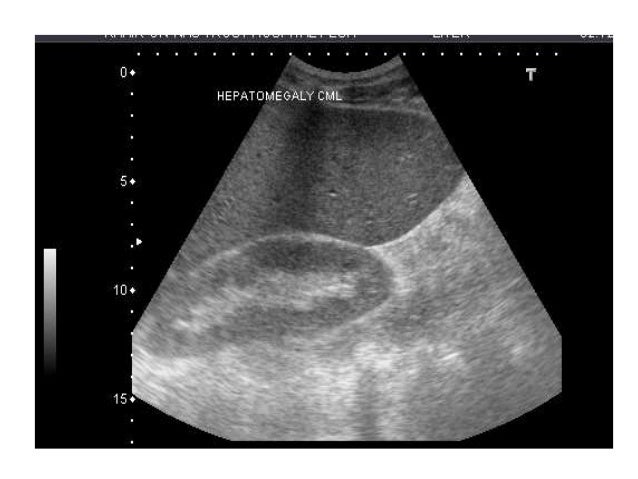 Presentation1 Liver Ultrasound Presentation1 Liver Ultrasound