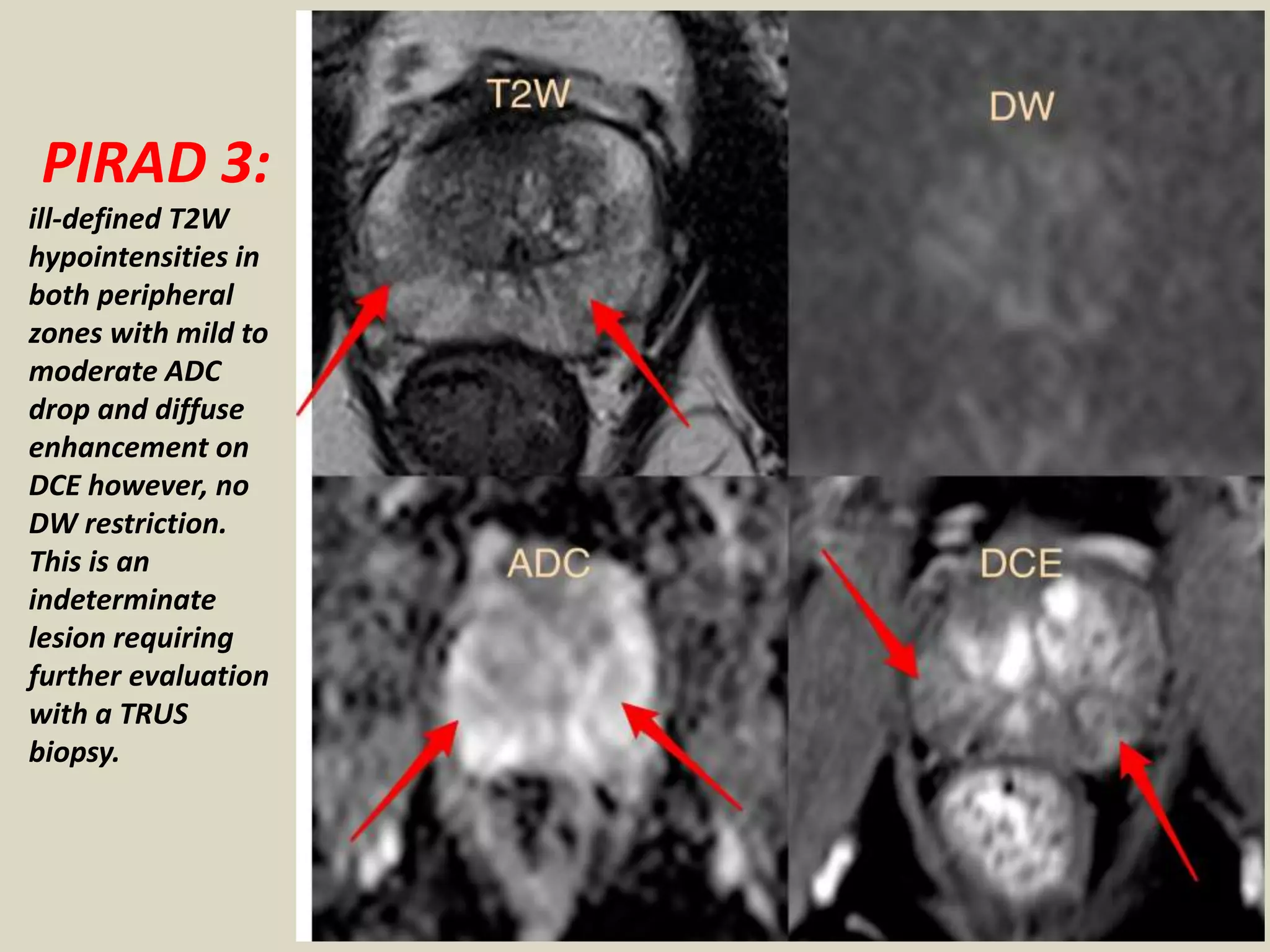 Presentation1, mri imaging of the prostate | PPTX