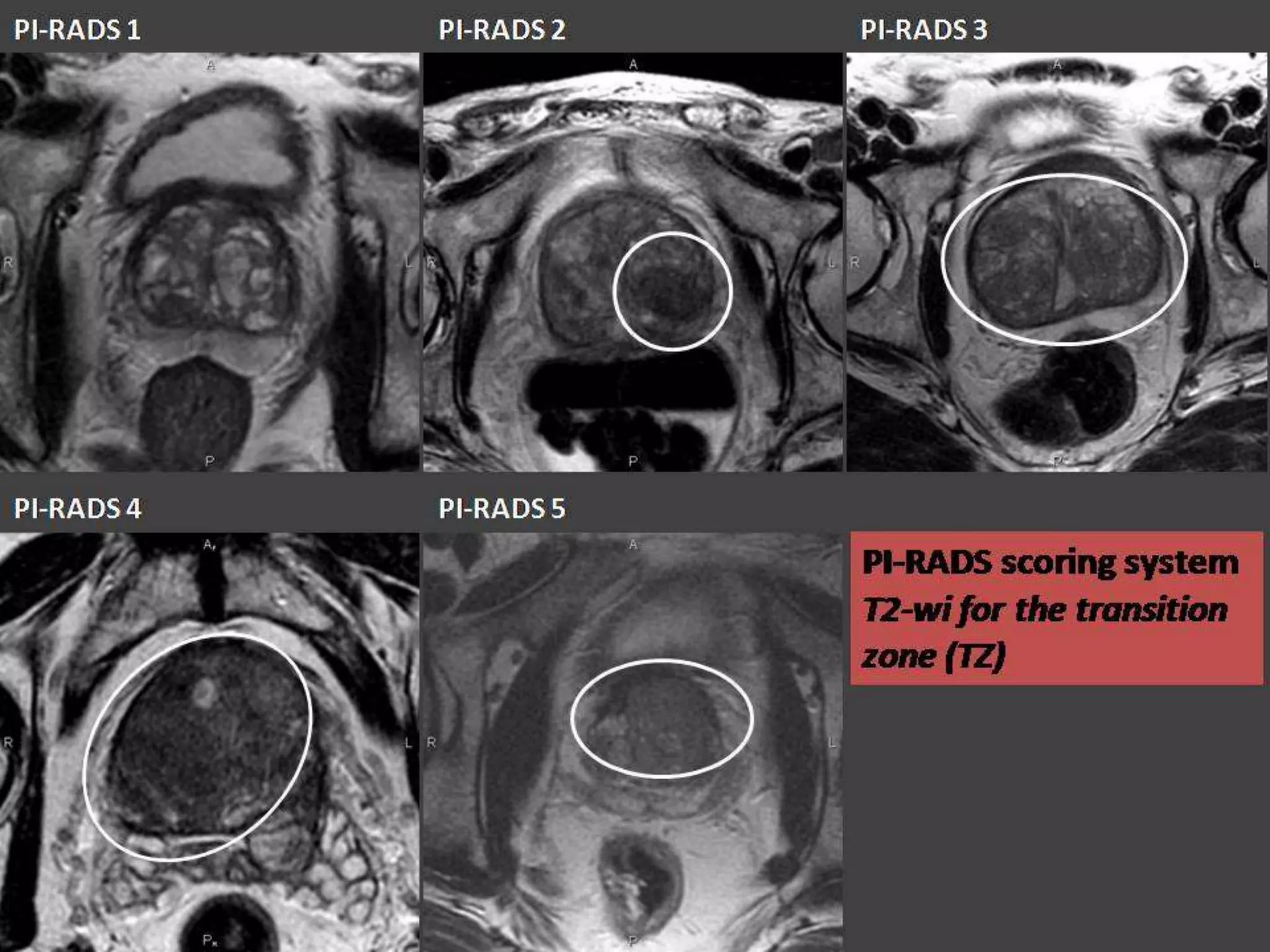 Prostate Mri Prep: The Surprising Reason To Avoid Caffeine - emgmrlw
