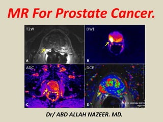 MR For Prostate Cancer.
Dr/ ABD ALLAH NAZEER. MD.
 