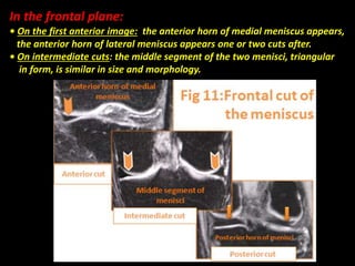 In the frontal plane:
• On the first anterior image: the anterior horn of medial meniscus appears,
the anterior horn of lateral meniscus appears one or two cuts after.
• On intermediate cuts: the middle segment of the two menisci, triangular
in form, is similar in size and morphology.
 